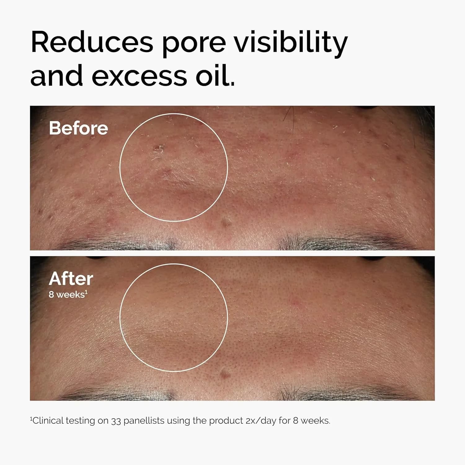 10% Niacinamide 1% Zinc Face Serum 30ml, Oil Contr - 3
